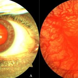 Hairnet like effect across vision