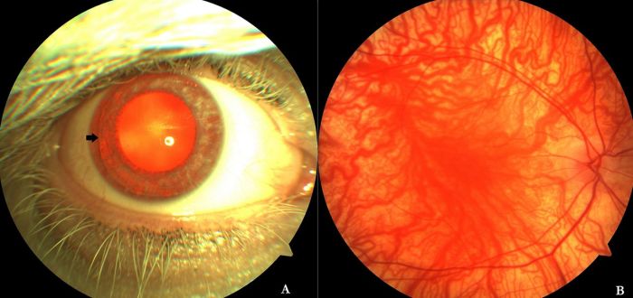 Hairnet like effect across vision