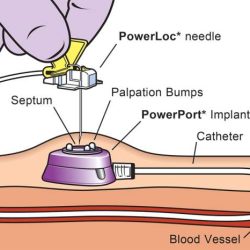 Port flushes fine but no blood return