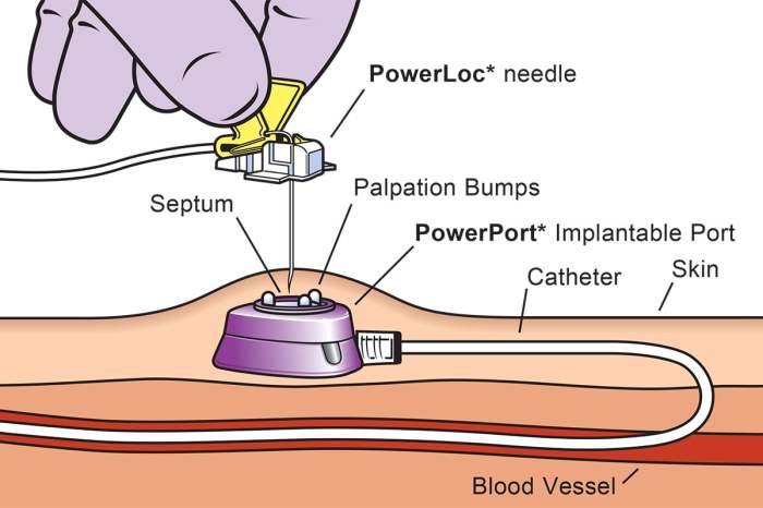 Port flushes fine but no blood return